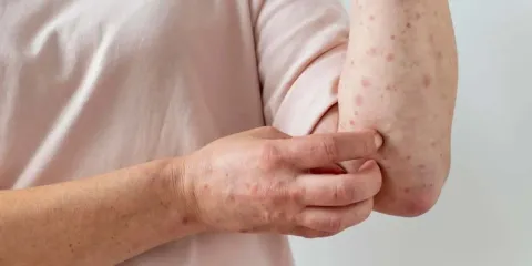 Brote de sarampión llega a los 32 estados de México y suma más de 7 mil casos