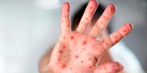 Brote de sarampión en México enciende alertas sanitarias y refuerzan vacunación nacional